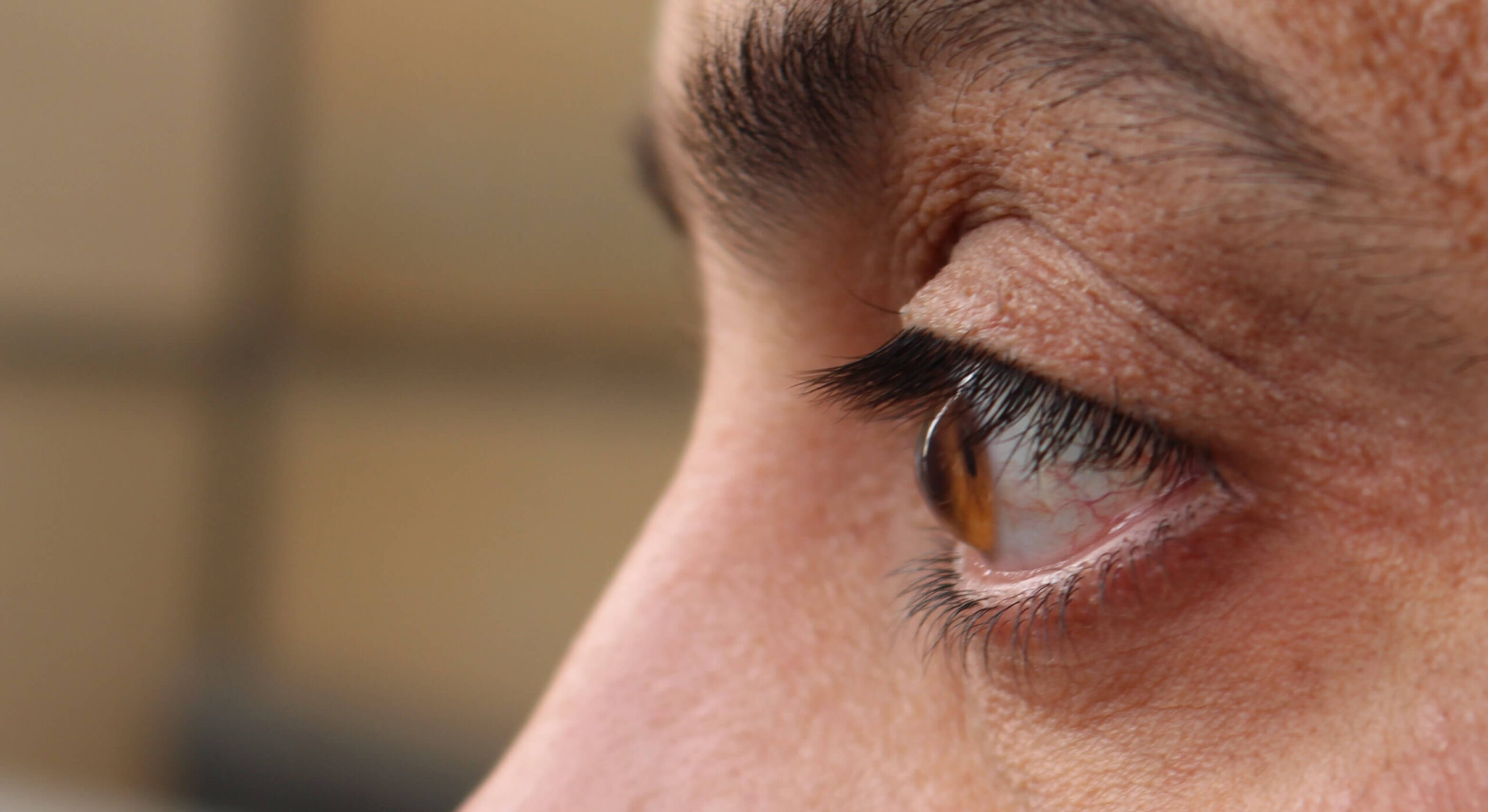 أسباب القرنية المخروطية