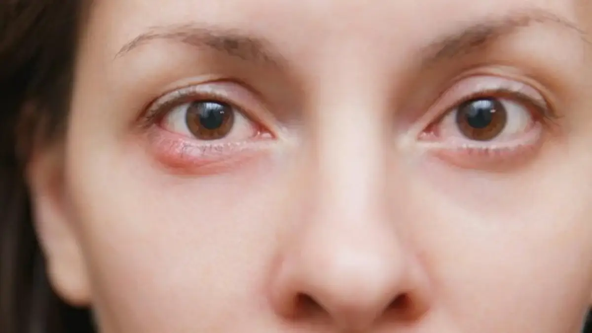 التهاب جفن العين السفلي